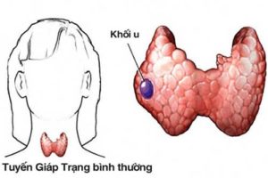 u-lành-tuyến-giáp-có-mua-được-bảo-hiểm-nhân-thọ
