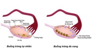 buồng-trứng-đa-nang-mua-được-bảo-hiểm-nhân-thọ-không