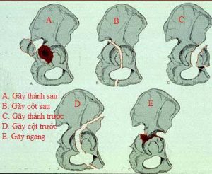 Vỡ ổ cối không được bảo hiểm chi trả